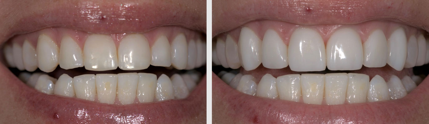 composite veneers before after - dentist in Billings, MT