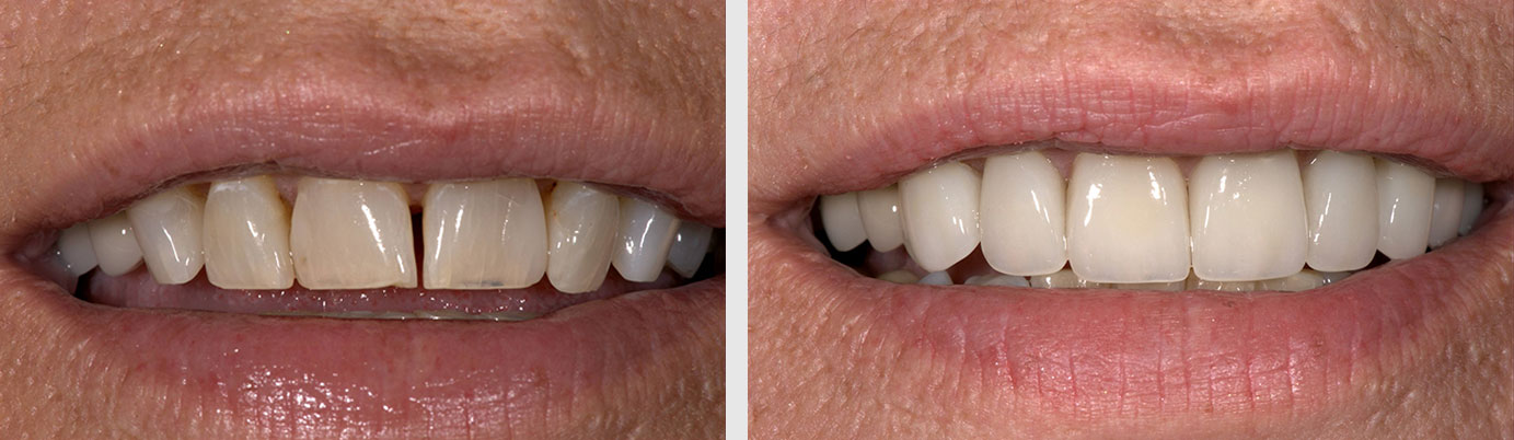 porcelain veneers before after - dentist in Billings, MT