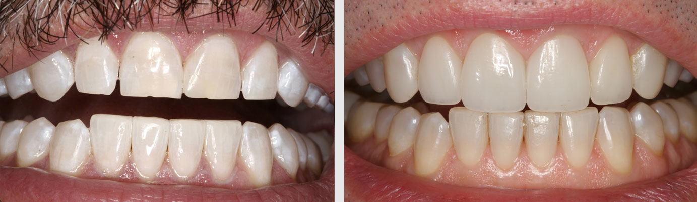 porcelain veneers before after - dentist in Billings, MT