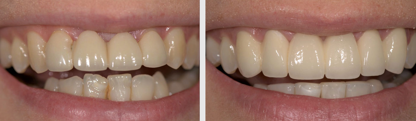 porcelain veneers before after - dentist in Billings, MT