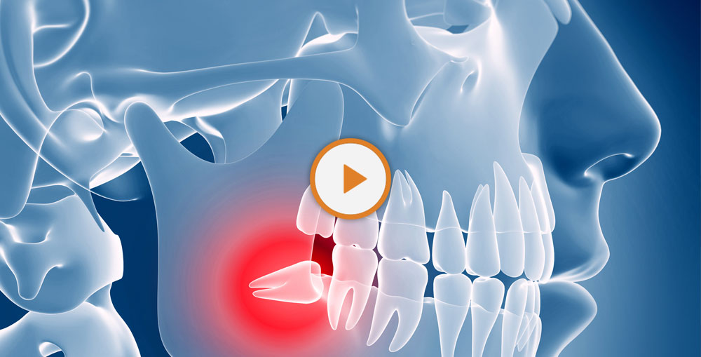 impacted wisdom teeth graphic