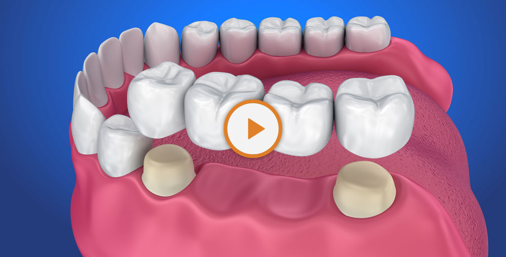 dental bridge graphic
