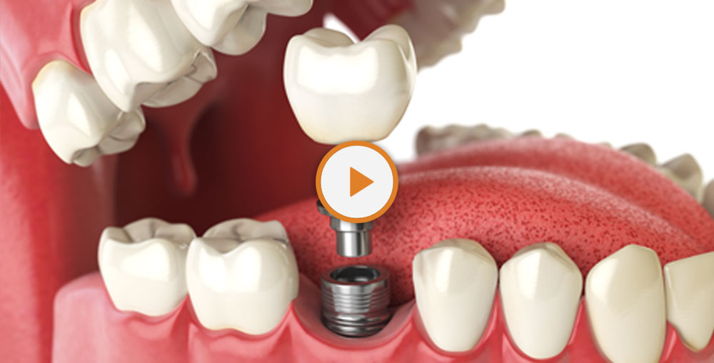 dental implants model