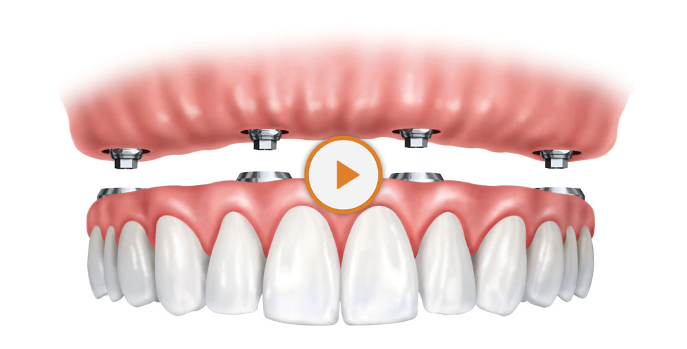 implant supported denture - dentist in Billings, MT