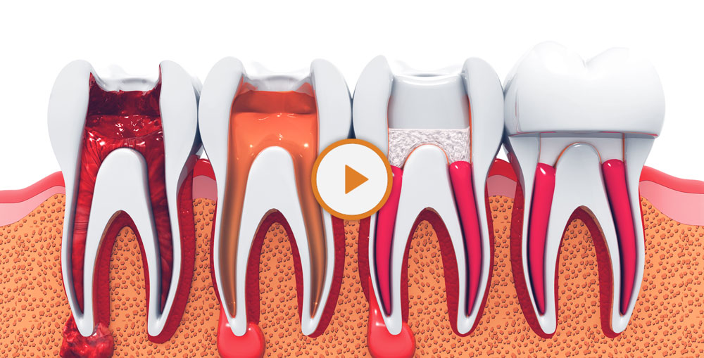 root canal process model