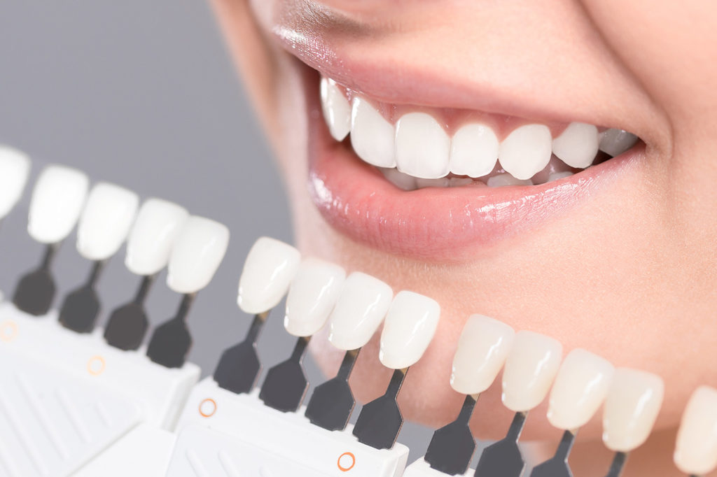 Teeth whitening - dentist in Billings, MT