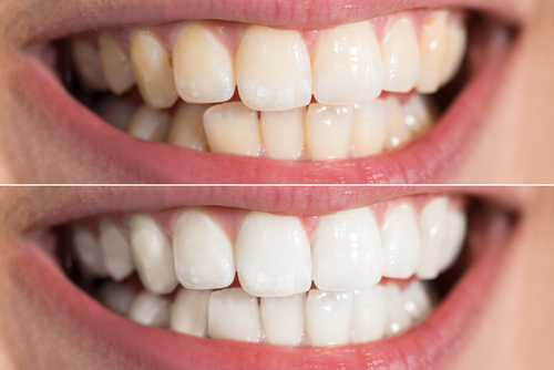 Tooth discoloration - tooth whitening treatments in Billings, MI