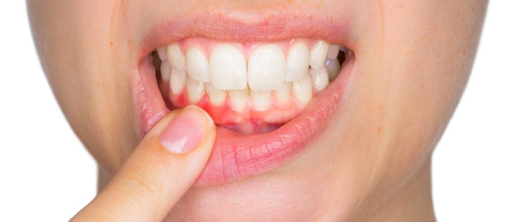 Periodontitis treatment at Thomas Smile Designs