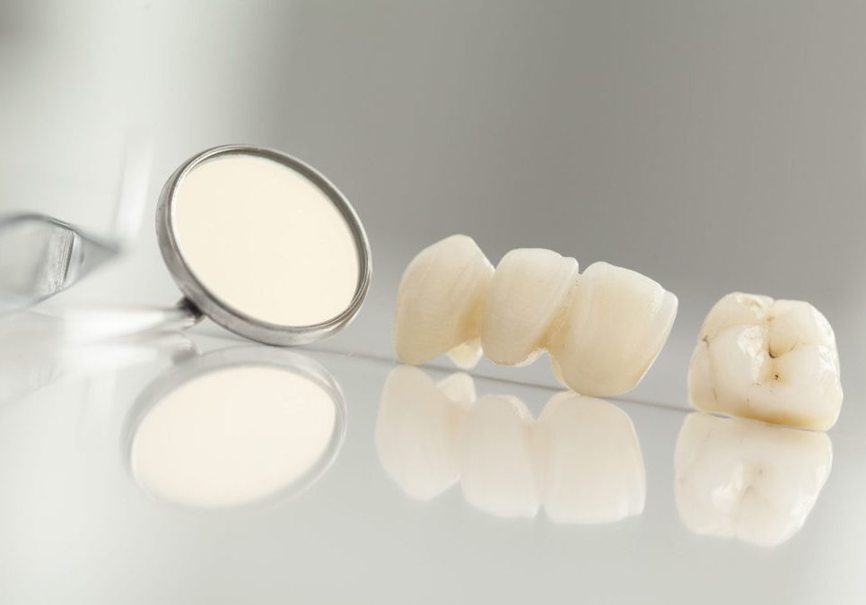 dental crown and bridge