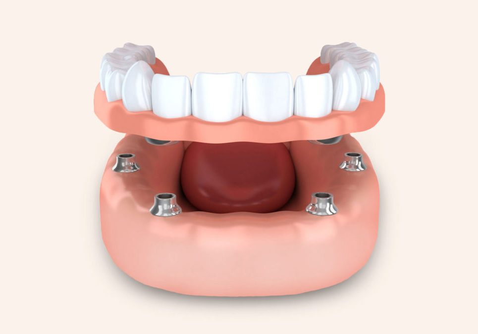 implant supported denture graphic - dentist in Billings, MT